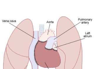 Les transplantations cardiaques