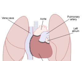 Les transplantations cardiaques