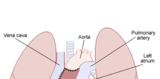 Les transplantations cardiaques