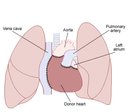 Les transplantations cardiaques