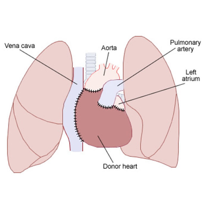 Les transplantations cardiaques